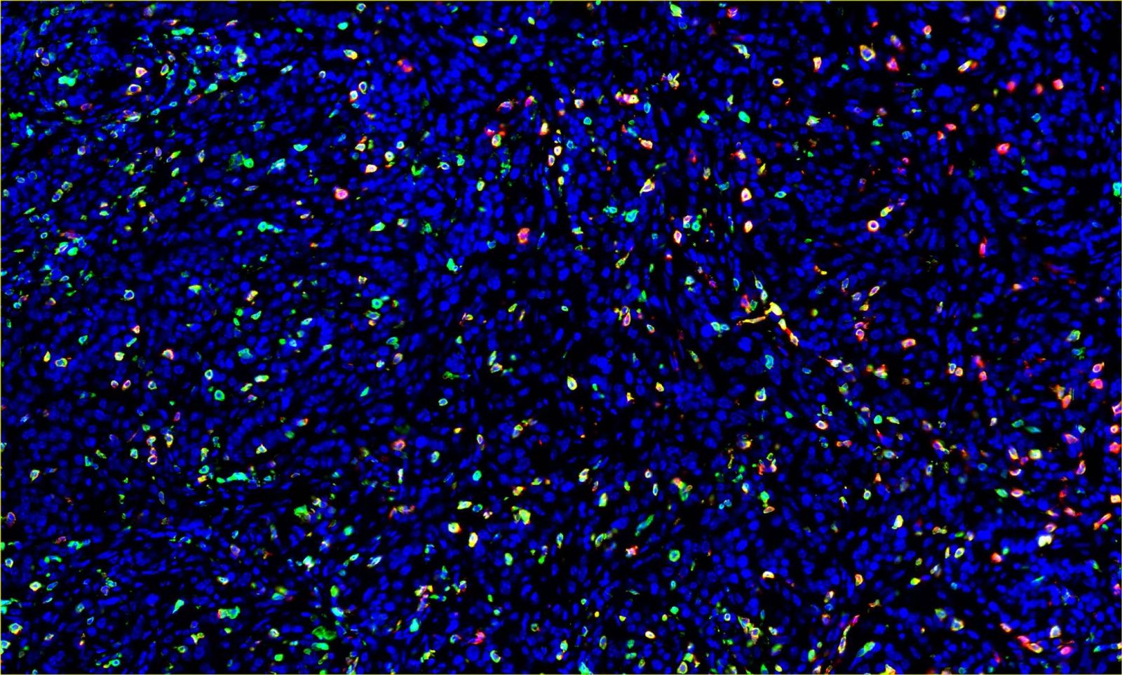 Melanoma tumor microenvironment imaged with CD45+ immune cells in green and CD8+ T cells in red